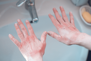 gereizte Hände die über das Waschbecken gehalten werden.